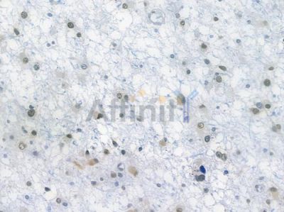 FTO Recombinant Rabbit mAb - BF3679 at 1/100 staining human astrocytoma by IHC-P.