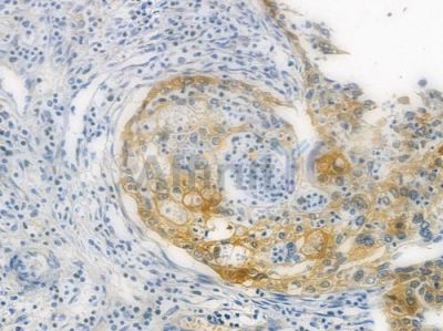Optineurin Recombinant Rabbit mAb - BF3688 at 1/100 staining human cervical carcinoma by IHC-P.
