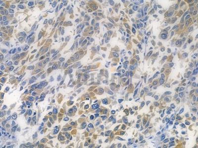 ALDH1A1 Recombinant Rabbit mAb - BF3691 at 1/100 staining human lung squamous cell carcinoma by IHC-P.