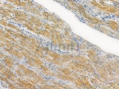 NRAS Recombinant Rabbit mAb - BF3701 at 1/100 staining human colon carcinoma by IHC-P.