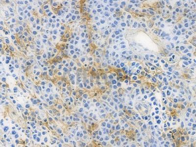 ACE1 Recombinant Rabbit mAb - BF3703 at 1/100 staining human non-Hodgkin lymphoma by IHC-P.