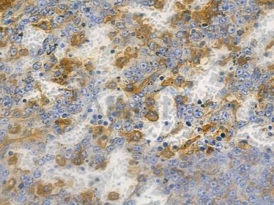 ACE1 Recombinant Rabbit mAb - BF3703 at 1/100 staining human melanoma by IHC-P.