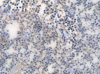 TCF4 Recombinant Rabbit mAb - BF3704 at 1/100 staining human pituitary adenoma by IHC-P.