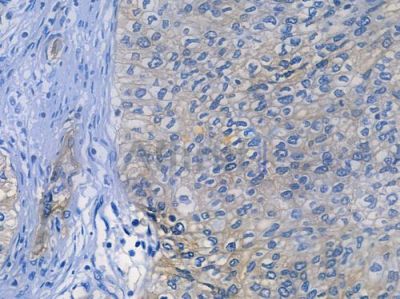 ITGA2 Recombinant Rabbit mAb - BF3705 at 1/100 staining human cervical carcinoma by IHC-P.