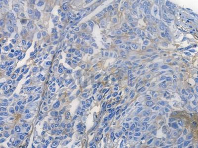 ITGA2 Recombinant Rabbit mAb - BF3705 at 1/100 staining human lung squamous cell carcinoma by IHC-P.