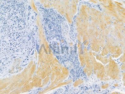 FXR1 Recombinant Rabbit mAb - BF3709 at 1/100 staining human gastric carcinoma by IHC-P.