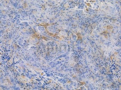 CD14 Recombinant Rabbit mAb - BF3729 at 1/100 staining human lung adenocarcinoma by IHC-P.