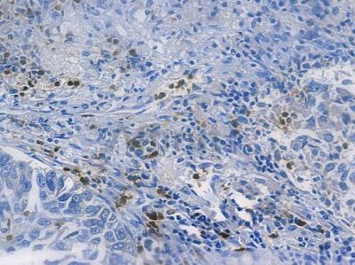 MMP8 Recombinant Rabbit mAb - BF3747 at 1/100 staining human lung squamous cell carcinoma by IHC-P.