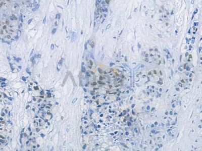 FOXC1 Recombinant Rabbit mAb - BF3771 at 1/100 staining human breast carcinoma by IHC-P.
