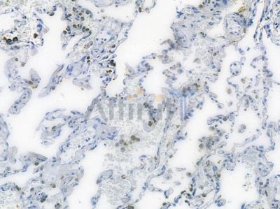 AurB Recombinant Rabbit mAb - BF3773 at 1/100 staining human small cell lung carcinoma by IHC-P.