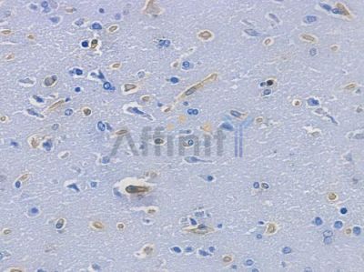 Filamin A Recombinant Rabbit mAb - BF3783 at 1/100 staining human glioblastoma by IHC-P.