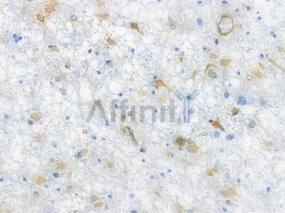Filamin A Recombinant Rabbit mAb - BF3783 at 1/100 staining human astrocytoma by IHC-P.
