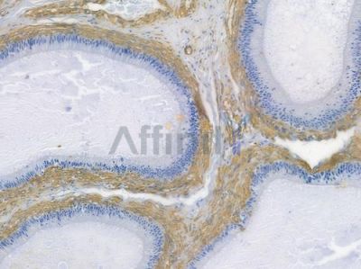 Filamin A Recombinant Rabbit mAb - BF3783 at 1/100 staining human testicular cancer by IHC-P.