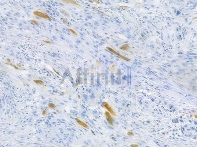 Raptor Recombinant Rabbit mAb - BF3794 at 1/100 staining human tongue carcinoma by IHC-P.