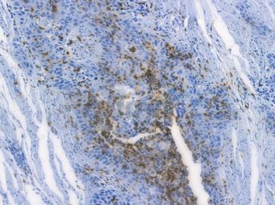 BIRC2 Recombinant Rabbit mAb - BF3829 at 1/100 staining human esophageal carcinoma by IHC-P.