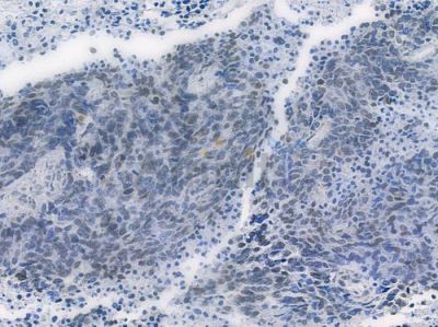 HDAC9 Recombinant Rabbit mAb - BF3833 at 1/100 staining human large cell lung carcinoma by IHC-P.