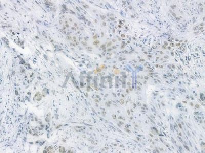 HDAC9 Recombinant Rabbit mAb - BF3833 at 1/100 staining human tongue carcinoma by IHC-P.