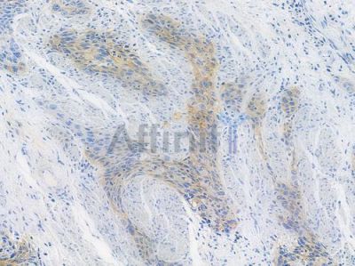 EphB2 Recombinant Rabbit mAb - BF3840 at 1/100 staining human esophageal carcinoma by IHC-P.