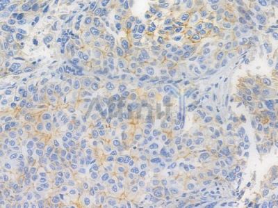 EphB2 Recombinant Rabbit mAb - BF3840 at 1/100 staining human lung squamous cell carcinoma by IHC-P.