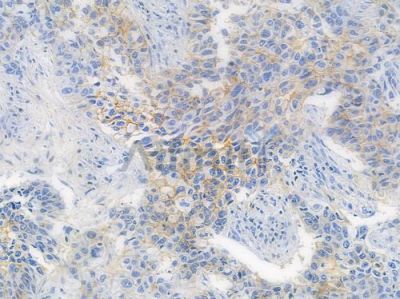 EphB2 Recombinant Rabbit mAb - BF3840 at 1/100 staining human lung squamous cell carcinoma by IHC-P.