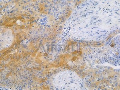 NDRG1 Recombinant Rabbit mAb - BF3848 at 1/100 staining human esophageal carcinoma by IHC-P.