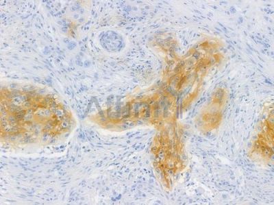 NDRG1 Recombinant Rabbit mAb - BF3848 at 1/100 staining human tongue carcinoma by IHC-P.
