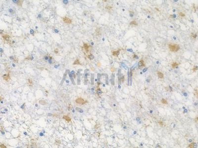 PLAU Recombinant Rabbit mAb - BF3851 at 1/100 staining human astrocytoma by IHC-P.