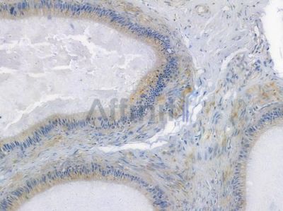 PLAU Recombinant Rabbit mAb - BF3851 at 1/100 staining human testicular cancer by IHC-P.