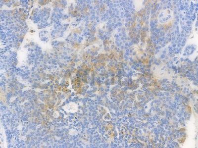 HLA-DPB1 Recombinant Rabbit mAb - BF3856 at 1/100 staining human ovarian carcinoma by IHC-P.
