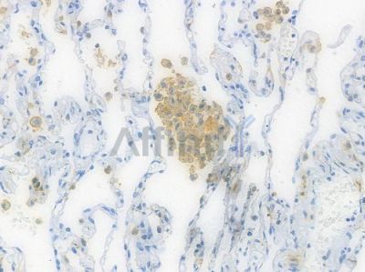 HLA-DPB1 Recombinant Rabbit mAb - BF3856 at 1/100 staining human small cell lung carcinoma by IHC-P.