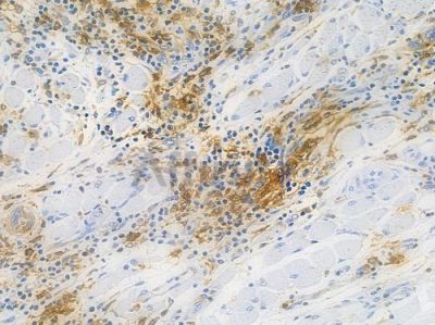HLA-DPB1 Recombinant Rabbit mAb - BF3856 at 1/100 staining human tongue carcinoma by IHC-P.