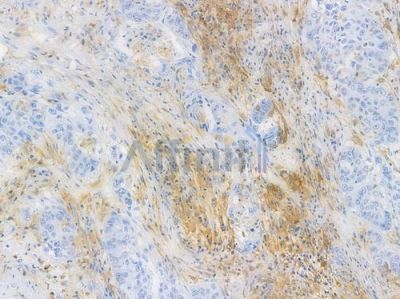 HLA-DPB1 Recombinant Rabbit mAb - BF3856 at 1/100 staining human lung squamous cell carcinoma by IHC-P.