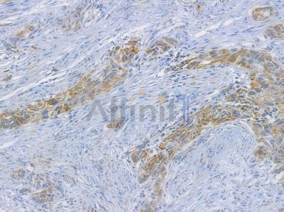 Hexokinase 1 Recombinant Rabbit mAb - BF3865 at 1/100 staining human tongue carcinoma by IHC-P.