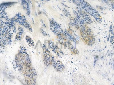 SRC3 Recombinant Rabbit mAb - BF3870 at 1/100 staining human breast carcinoma by IHC-P.