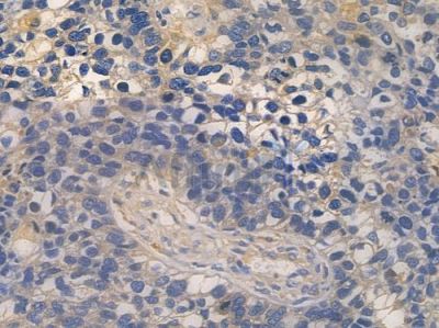 ATP6V1B2 Antibody - DF10004 at 1/100 staining human glioblastoma by IHC-P.