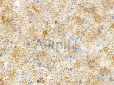 RHCG Antibody - DF10084 at 1/100 staining human astrocytoma by IHC-P.