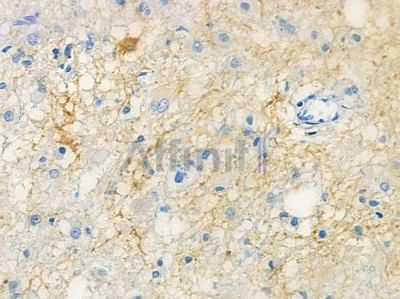 BDKRB1 Antibody - DF10199 at 1/100 staining human astrocytoma by IHC-P.