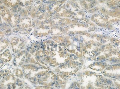 PDE6A Antibody - DF12446 at 1/100 staining human renal cell carcinoma by IHC-P.