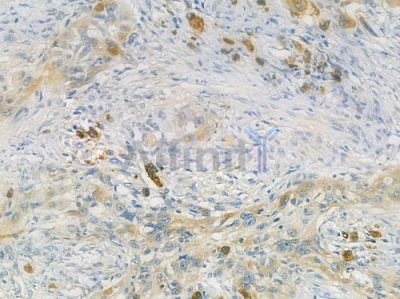 PDE6A Antibody - DF12446 at 1/100 staining human tongue carcinoma by IHC-P.
