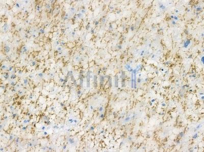 ARL15 Antibody - DF12559 at 1/100 staining human astrocytoma by IHC-P.