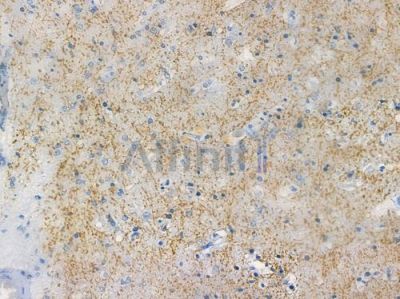 ARL15 Antibody - DF12559 at 1/100 staining human glioblastoma by IHC-P.