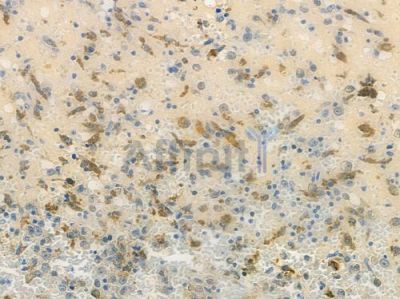 GALE Antibody - DF12611 at 1/100 staining human melanoma by IHC-P.