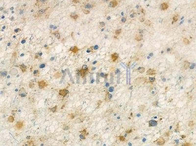 RARG Antibody - DF12718 at 1/100 staining human astrocytoma by IHC-P.