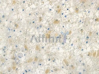 TALDO1 Antibody - DF12764 at 1/100 staining human astrocytoma by IHC-P.