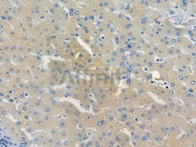 CRACR2A Antibody - DF12914 at 1/100 staining human hepatocellular carcinoma by IHC-P.