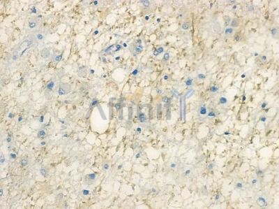 Exo70 Antibody - DF12988 at 1/100 staining human astrocytoma by IHC-P.