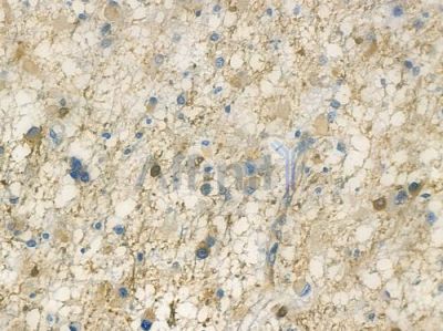 MLN64 Antibody - DF13153 at 1/100 staining human astrocytoma by IHC-P.