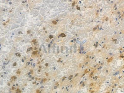ESE1 Antibody - DF13530 at 1/100 staining human melanoma by IHC-P.