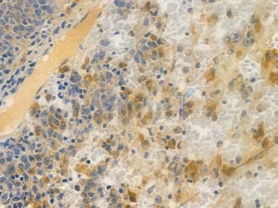 BTF3 Antibody - DF13811 at 1/100 staining human melanoma by IHC-P.