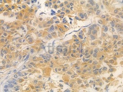 TMEM199 Antibody - DF13885 at 1/100 staining human lung squamous cell carcinoma by IHC-P.